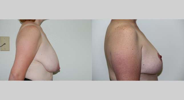 Breast Reduction: Image #460