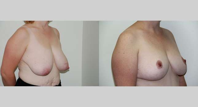 Breast Reduction: Image #461