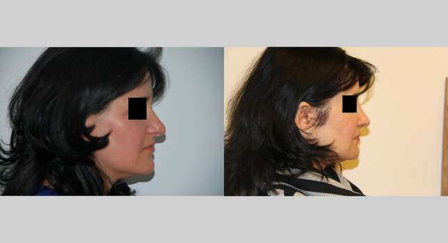 Nose Surgery: Image #462