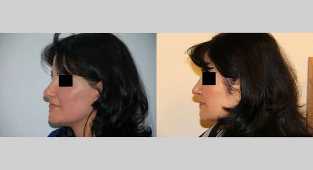 Nose Surgery: Image #463
