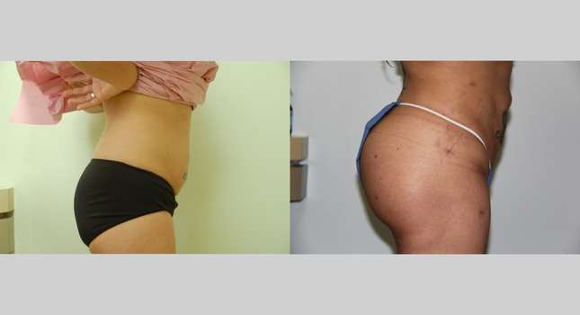Butock and Thigh Contouring: Image #469