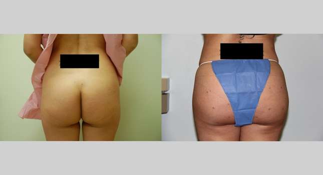 Butock and Thigh Contouring: Image #470