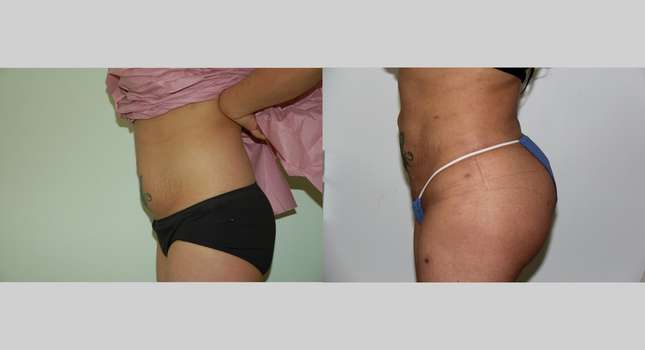 Butock and Thigh Contouring: Image #471