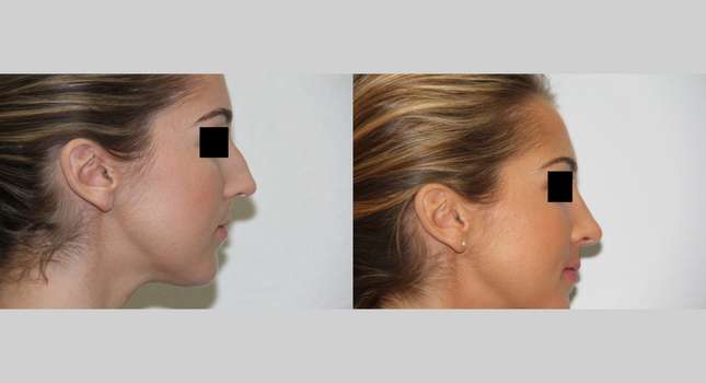 Nose Surgery: Image #525