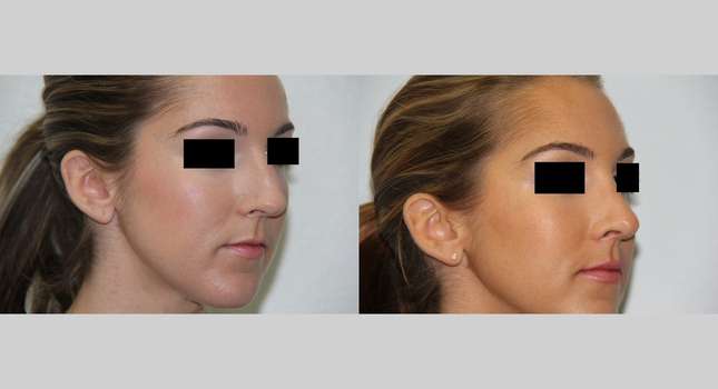 Nose Surgery: Image #526