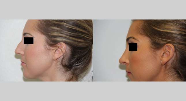 Nose Surgery: Image #527