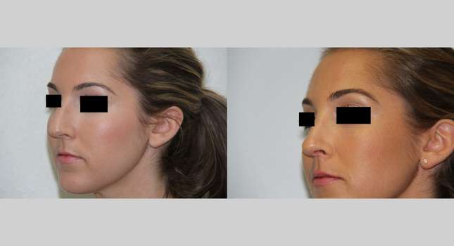 Nose Surgery: Image #528