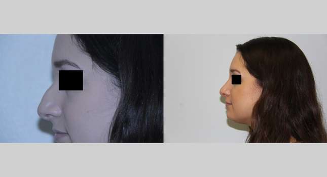 Nose Surgery: Image #529