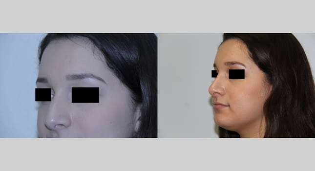 Nose Surgery: Image #530