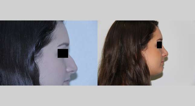 Nose Surgery: Image #531