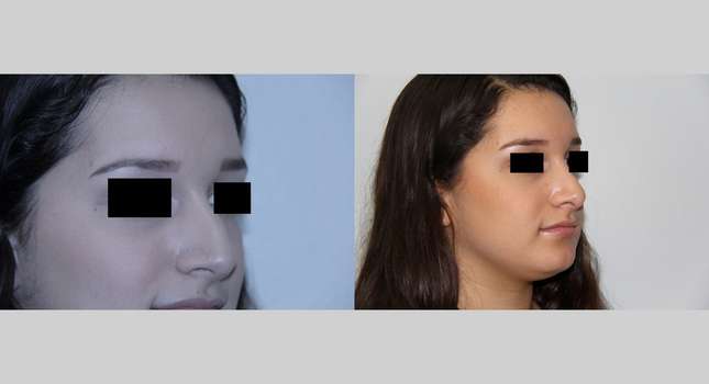 Nose Surgery: Image #532