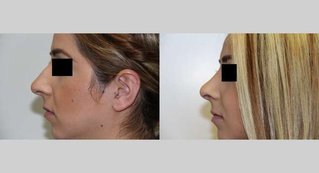Nose Surgery: Image #534