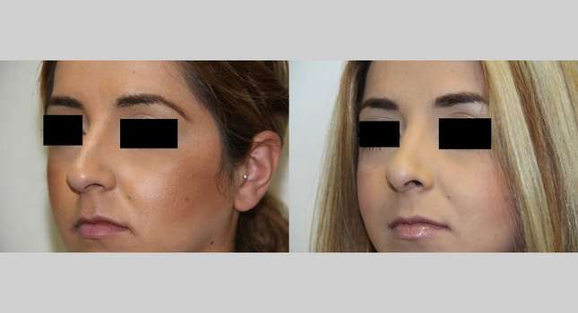Nose Surgery: Image #535