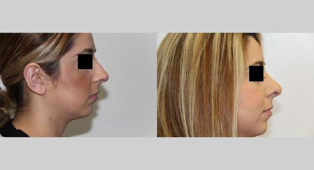 Nose Surgery: Image #536