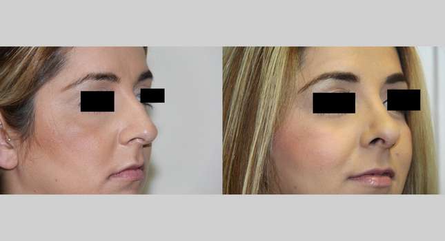 Nose Surgery: Image #537