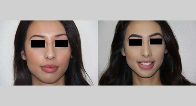 Nose Surgery: Image #538