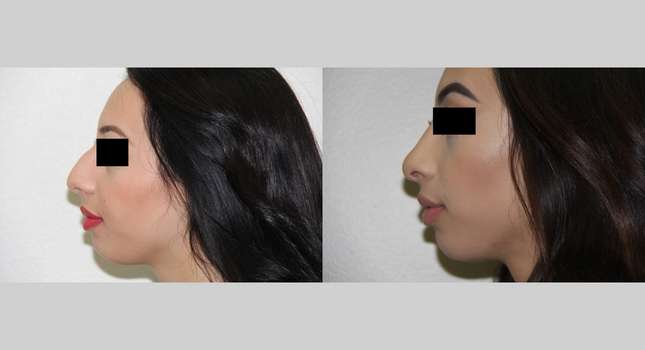 Nose Surgery: Image #539