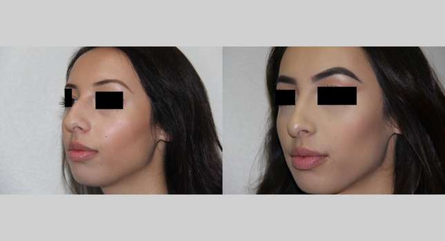 Nose Surgery: Image #540