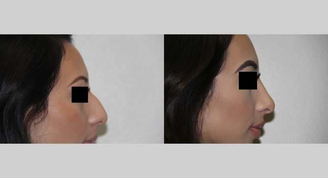 Nose Surgery: Image #541