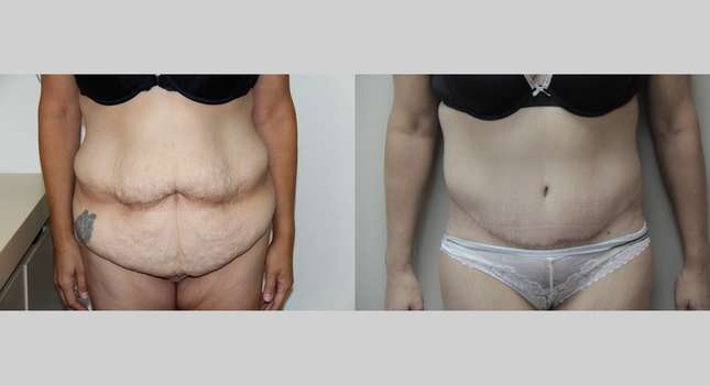 Body Lift: Image #561