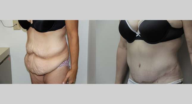 Body Lift: Image #563
