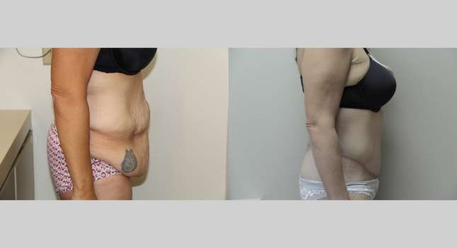 Body Lift: Image #564
