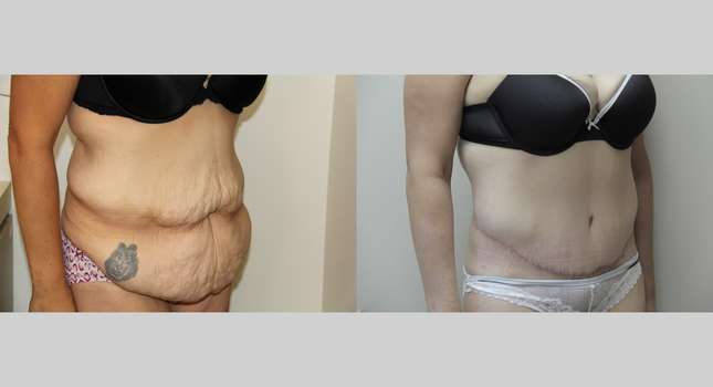 Body Lift: Image #565