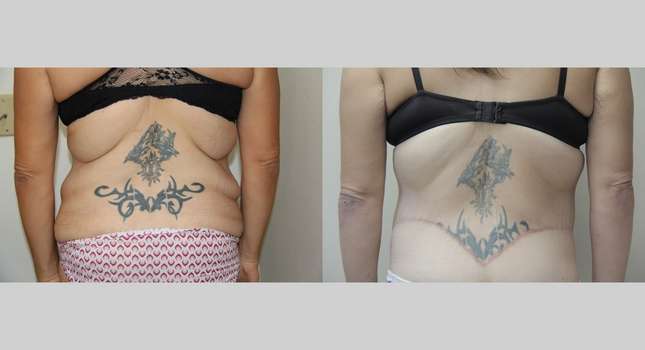 Body Lift: Image #566