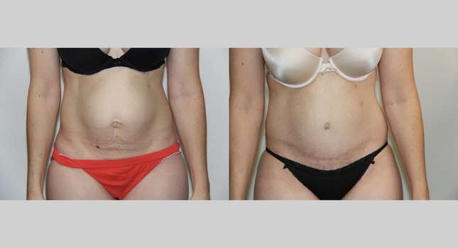 Tummy Tuck: Image #573