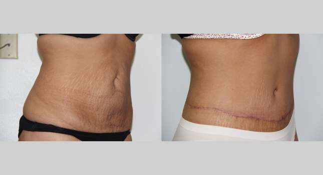 Body Lift: Image #582