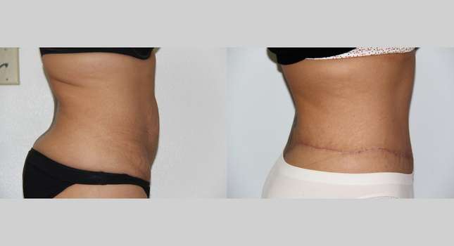 Body Lift: Image #583