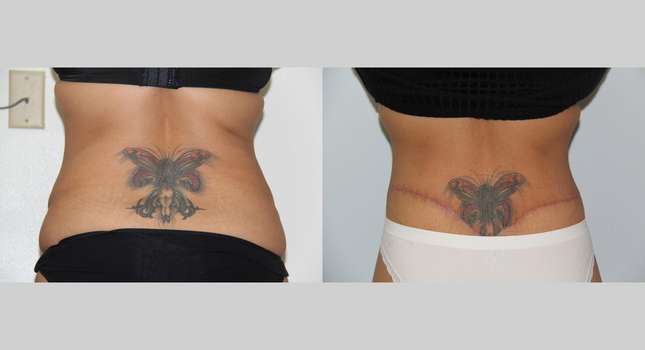 Body Lift: Image #584