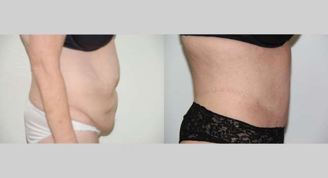 Body Lift: Image #588