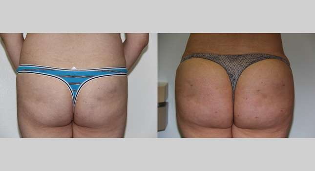 Butock and Thigh Contouring: Image #589