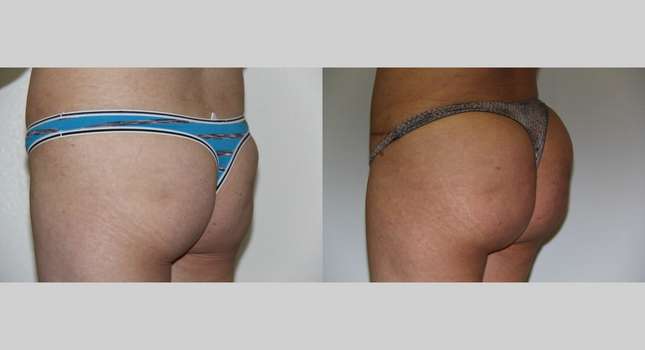 Butock and Thigh Contouring: Image #590