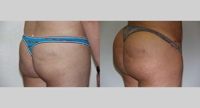 Butock and Thigh Contouring: Image #591