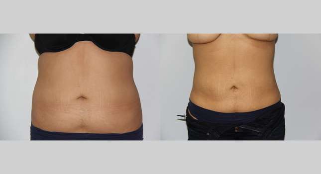Liposuction: Image #592