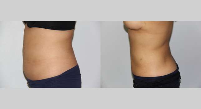 Liposuction: Image #593