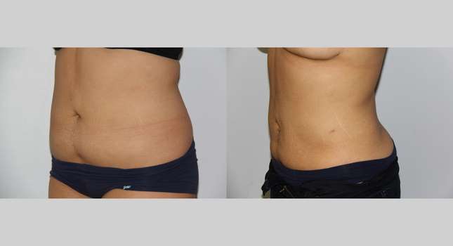 Liposuction: Image #594