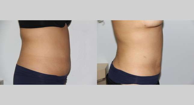 Liposuction: Image #595