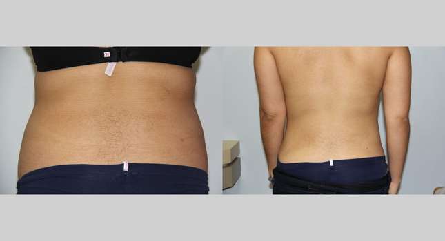 Liposuction: Image #596