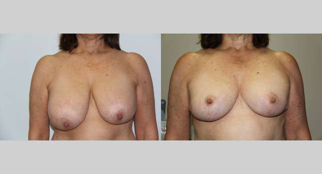 Breast Reduction: Image #605
