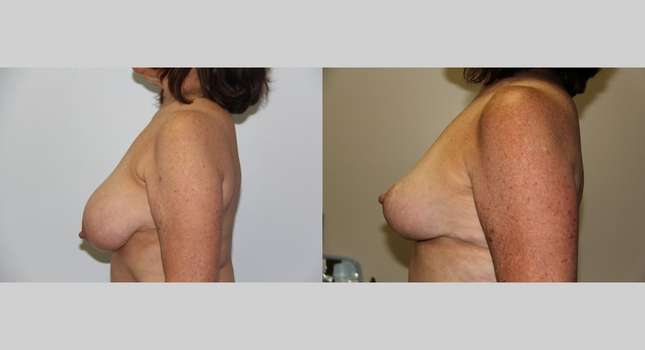 Breast Reduction: Image #606