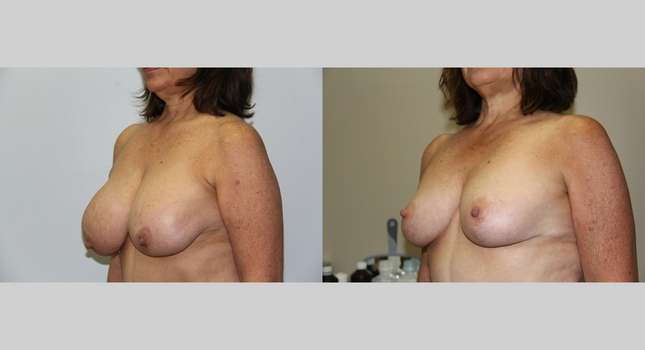 Breast Reduction: Image #607