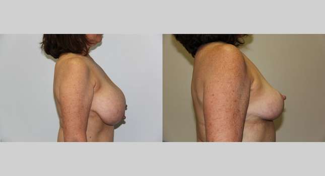Breast Reduction: Image #608