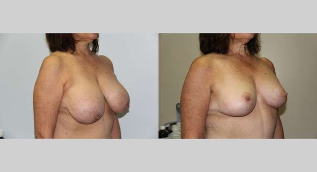 Breast Reduction: Image #609