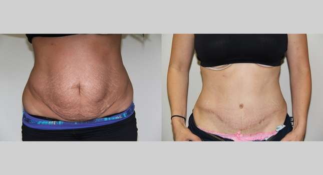 Tummy Tuck: Image #610