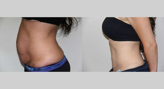 Tummy Tuck: Image #611