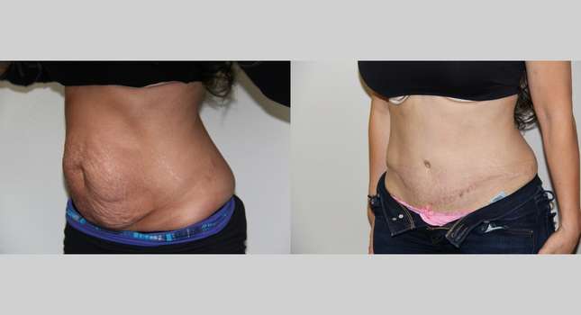 Tummy Tuck: Image #612