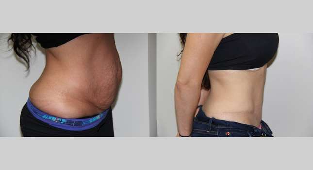 Tummy Tuck: Image #613